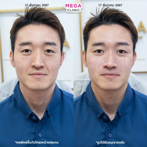 ฟิลเลอร์หลายบริเวณที่ MEGA CLINIC กรุงเทพ และปริมณฑล สยามสแควร์ เซ็นทรัลลาดพร้าว ฟิวเจอร์พาร์ค รังสิต เซ็นทรัลเวสต์เกต ปากน้ำ