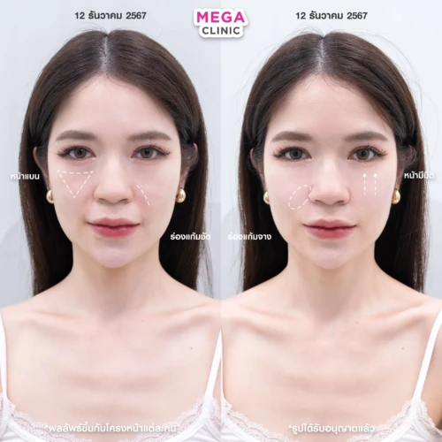 ฟิลเลอร์หลายบริเวณที่ MEGA CLINIC กรุงเทพ และปริมณฑล สยามสแควร์ เซ็นทรัลลาดพร้าว ฟิวเจอร์พาร์ค รังสิต เซ็นทรัลเวสต์เกต ปากน้ำ