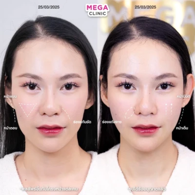 ฟิลเลอร์หลายบริเวณที่ MEGA CLINIC กรุงเทพ และปริมณฑล สยามสแควร์ เซ็นทรัลลาดพร้าว ฟิวเจอร์พาร์ค รังสิต เซ็นทรัลเวสต์เกต ปากน้ำ