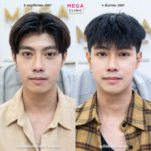 ฟิลเลอร์หลายบริเวณที่ MEGA CLINIC กรุงเทพ และปริมณฑล สยามสแควร์ เซ็นทรัลลาดพร้าว ฟิวเจอร์พาร์ค รังสิต เซ็นทรัลเวสต์เกต ปากน้ำ