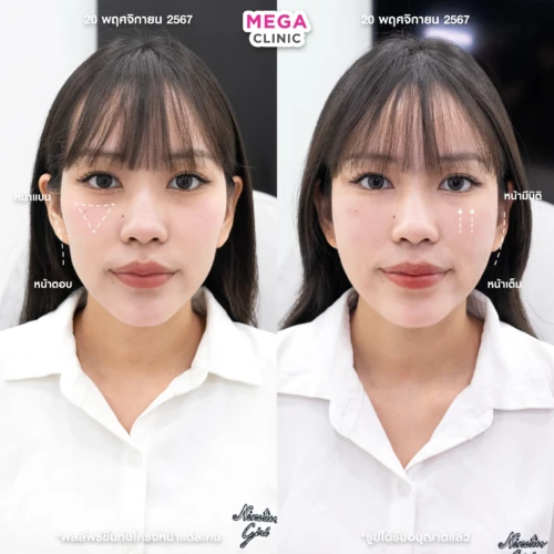 ฟิลเลอร์หลายบริเวณที่ MEGA CLINIC กรุงเทพ และปริมณฑล สยามสแควร์ เซ็นทรัลลาดพร้าว ฟิวเจอร์พาร์ค รังสิต เซ็นทรัลเวสต์เกต ปากน้ำ