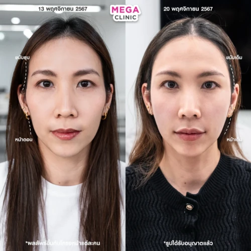 ฟิลเลอร์หลายบริเวณที่ MEGA CLINIC กรุงเทพ และปริมณฑล สยามสแควร์ เซ็นทรัลลาดพร้าว ฟิวเจอร์พาร์ค รังสิต เซ็นทรัลเวสต์เกต ปากน้ำ