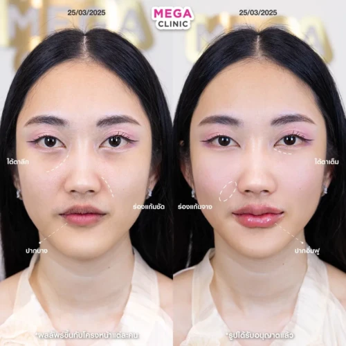 ฟิลเลอร์หลายบริเวณที่ MEGA CLINIC กรุงเทพ และปริมณฑล สยามสแควร์ เซ็นทรัลลาดพร้าว ฟิวเจอร์พาร์ค รังสิต เซ็นทรัลเวสต์เกต ปากน้ำ