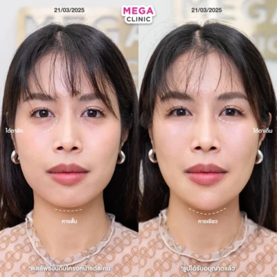 ฟิลเลอร์หลายบริเวณที่ MEGA CLINIC กรุงเทพ และปริมณฑล สยามสแควร์ เซ็นทรัลลาดพร้าว ฟิวเจอร์พาร์ค รังสิต เซ็นทรัลเวสต์เกต ปากน้ำ