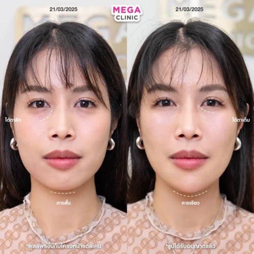 ฟิลเลอร์หลายบริเวณที่ MEGA CLINIC กรุงเทพ และปริมณฑล สยามสแควร์ เซ็นทรัลลาดพร้าว ฟิวเจอร์พาร์ค รังสิต เซ็นทรัลเวสต์เกต ปากน้ำ