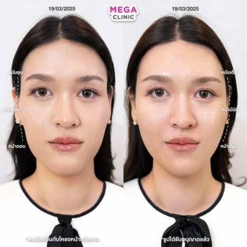 ฟิลเลอร์หลายบริเวณที่ MEGA CLINIC กรุงเทพ และปริมณฑล สยามสแควร์ เซ็นทรัลลาดพร้าว ฟิวเจอร์พาร์ค รังสิต เซ็นทรัลเวสต์เกต ปากน้ำ