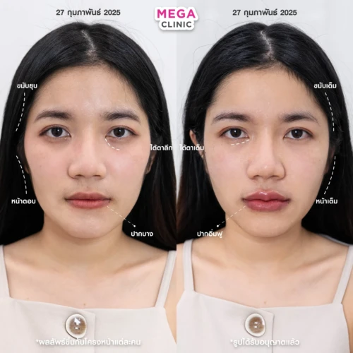 ฟิลเลอร์หลายบริเวณที่ MEGA CLINIC กรุงเทพ และปริมณฑล สยามสแควร์ เซ็นทรัลลาดพร้าว ฟิวเจอร์พาร์ค รังสิต เซ็นทรัลเวสต์เกต ปากน้ำ