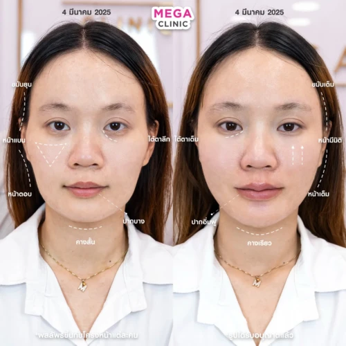 ฟิลเลอร์หลายบริเวณที่ MEGA CLINIC กรุงเทพ และปริมณฑล สยามสแควร์ เซ็นทรัลลาดพร้าว ฟิวเจอร์พาร์ค รังสิต เซ็นทรัลเวสต์เกต ปากน้ำ