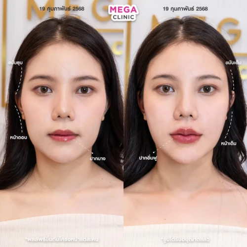 ฟิลเลอร์หลายบริเวณที่ MEGA CLINIC กรุงเทพ และปริมณฑล สยามสแควร์ เซ็นทรัลลาดพร้าว ฟิวเจอร์พาร์ค รังสิต เซ็นทรัลเวสต์เกต ปากน้ำ