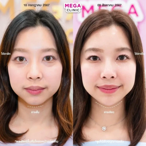 ฟิลเลอร์หลายบริเวณที่ MEGA CLINIC กรุงเทพ และปริมณฑล สยามสแควร์ เซ็นทรัลลาดพร้าว ฟิวเจอร์พาร์ค รังสิต เซ็นทรัลเวสต์เกต ปากน้ำ