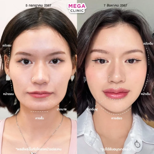 ฟิลเลอร์หลายบริเวณที่ MEGA CLINIC กรุงเทพ และปริมณฑล สยามสแควร์ เซ็นทรัลลาดพร้าว ฟิวเจอร์พาร์ค รังสิต เซ็นทรัลเวสต์เกต ปากน้ำ