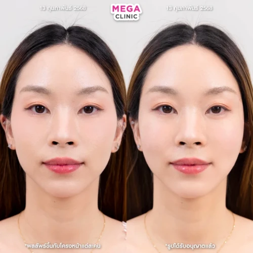 ฟิลเลอร์ขมับ และแก้มตอบ