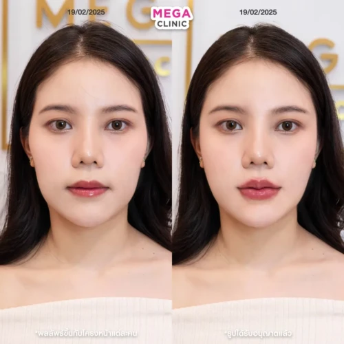 ฟิลเลอร์ขมับและแก้มตอบ