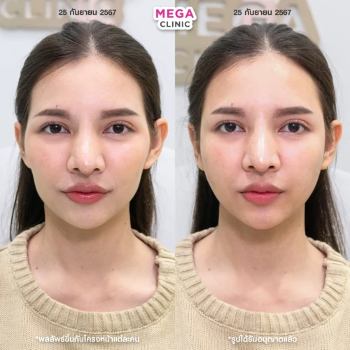 ฟิลเลอร์ขมับและแก้มตอบ