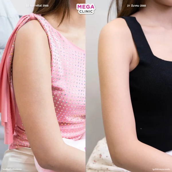 ฉีดแฟตลดไขมันแก้ม ต้นแขน แก้รักแร้ปลิ้น แขนใหญ่