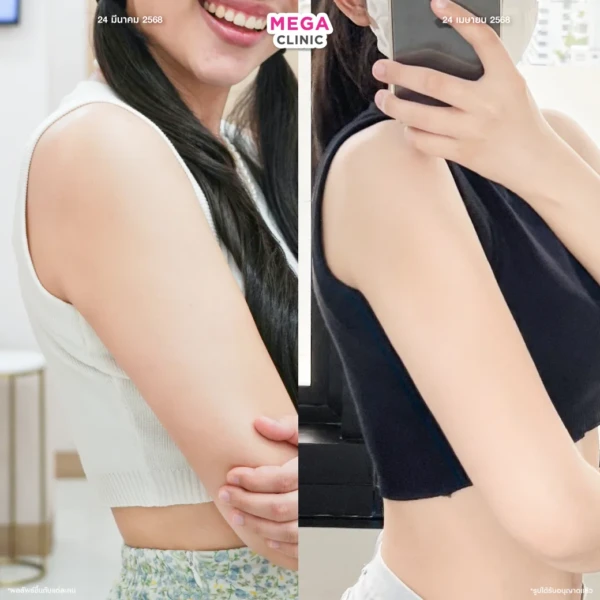 ฉีดแฟตลดไขมันแก้ม ต้นแขน แก้รักแร้ปลิ้น แขนใหญ่