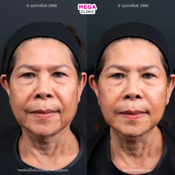 รีวิว HArmonyCa ลดร่องแก้ม ร่องน้ำหมาก