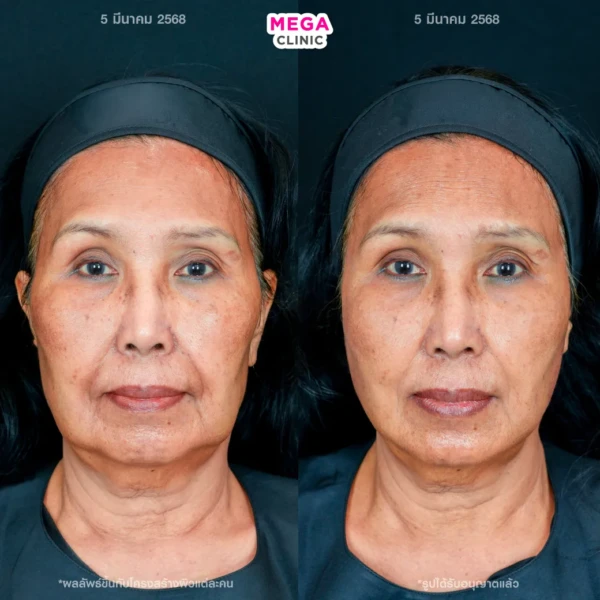 รีวิว HArmonyCa ลดกระเปาะแก้ม ห้อยคล้อย