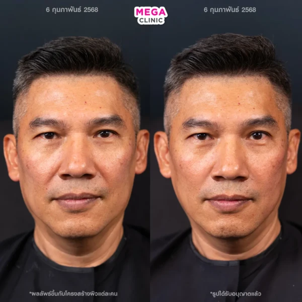 รีวิว HArmonyCa ลดผิวหย่อน ไม่เฟิร์ม