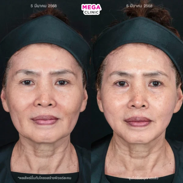 รีวิว HArmonyCa