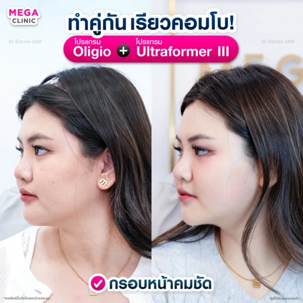 รีวิว oligio และ ultraformer เมื่อทำคู่กัน รีวิว oligio และ ultraformer เมื่อทำคู่กัน