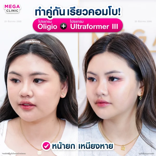 รีวิว oligio และ ultraformer เมื่อทำคู่กัน รีวิว oligio และ ultraformer เมื่อทำคู่กัน