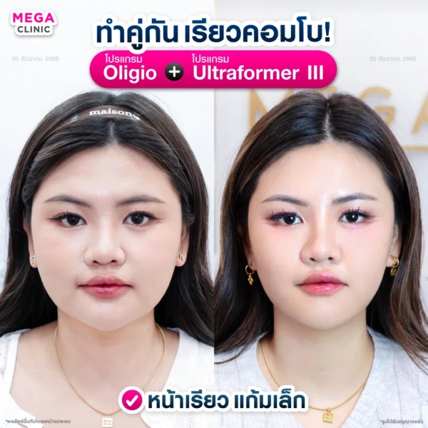 รีวิว oligio และ ultraformer เมื่อทำคู่กัน รีวิว oligio และ ultraformer เมื่อทำคู่กัน