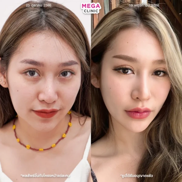 thermage รีวิวก่อนและหลังยกกระชับ