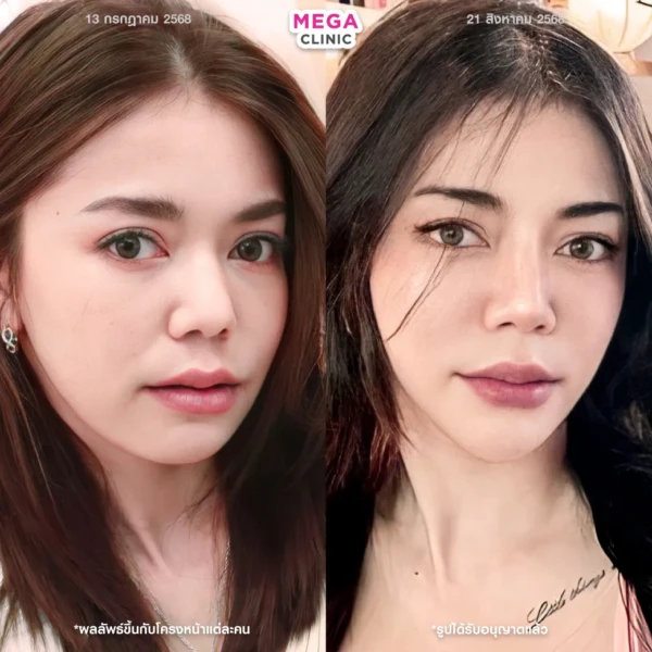thermage รีวิวก่อนและหลังยกกระชับ