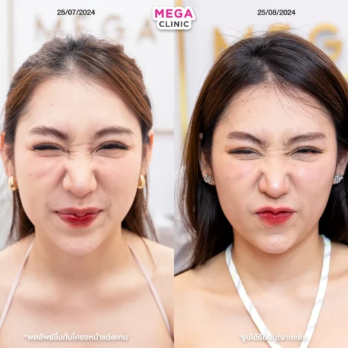 โบท็อกจมูก แก้จมูกบาน