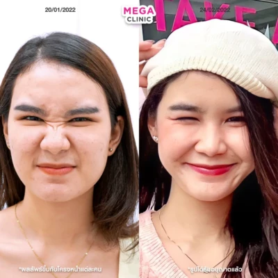 โบท็อกจมูก แก้จมูกบาน