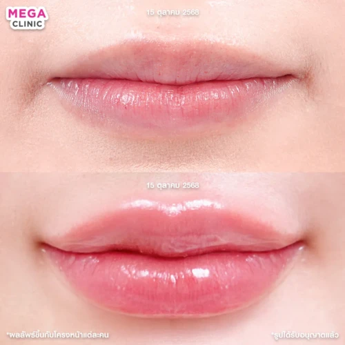 รีวิวฉีดปาก 1