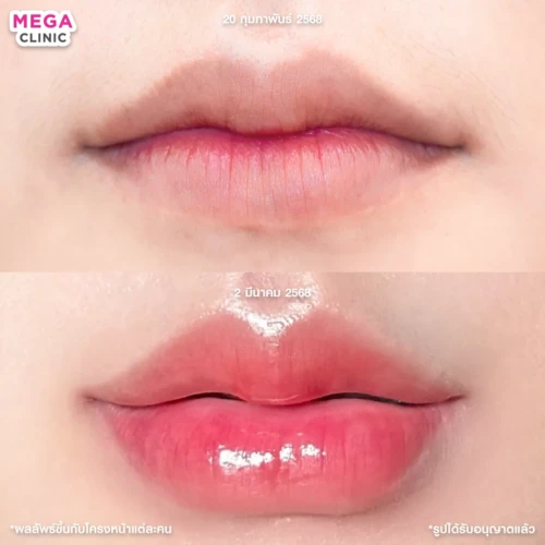 รีวิวฉีดปาก 1