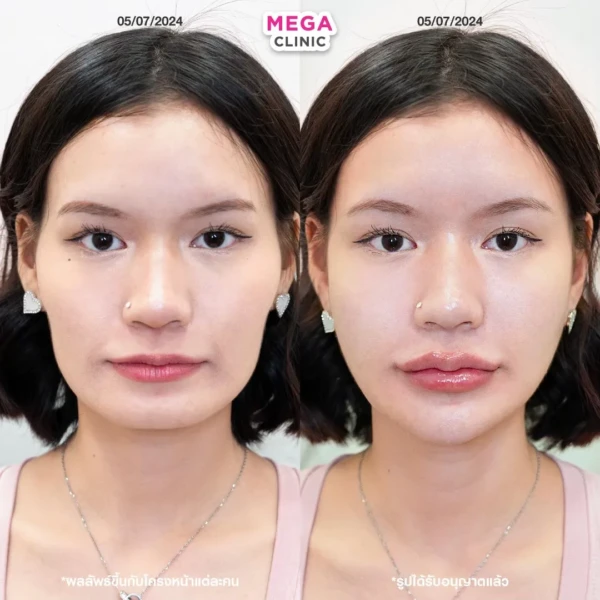 รีวิวฟิลเลอร์แก้มตอบ ขมับ คาง และทรงปาก