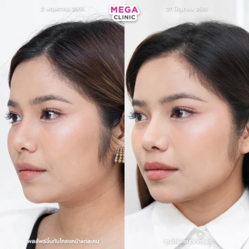 โบท็อกลิฟกรอบหน้า ช่วยหน้าเรียว