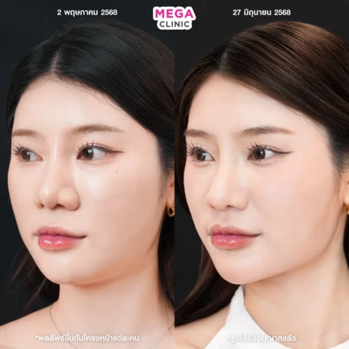 โบท็อกลิฟกรอบหน้า ช่วยหน้าเรียว