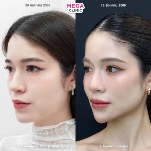 โบท็อกลิฟกรอบหน้า ช่วยหน้าเรียว