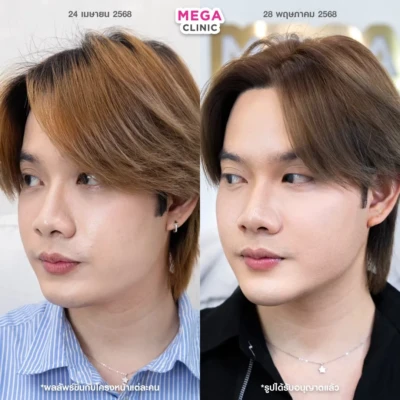 รีวิวโบท็อกลิฟกรอบหน้า