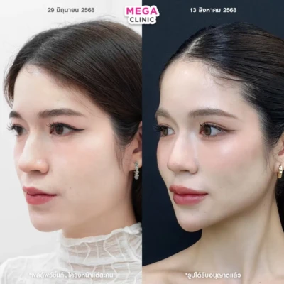 รีวิวโบท็อกลิฟกรอบหน้า