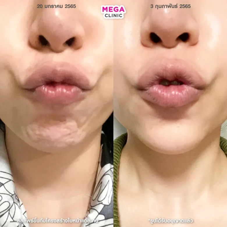 ผลลัพธ์หลังฉีดโบท็อกคาง